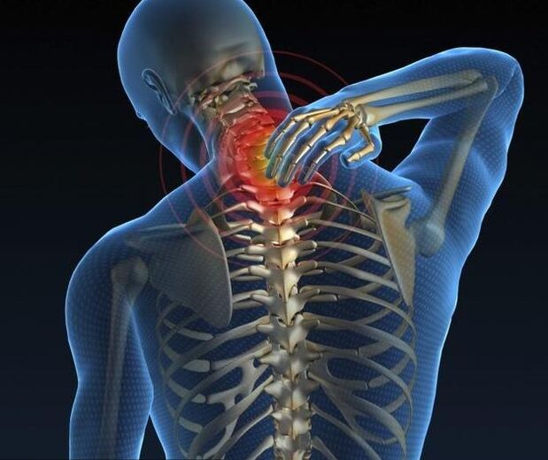 Cervikálna osteochondróza