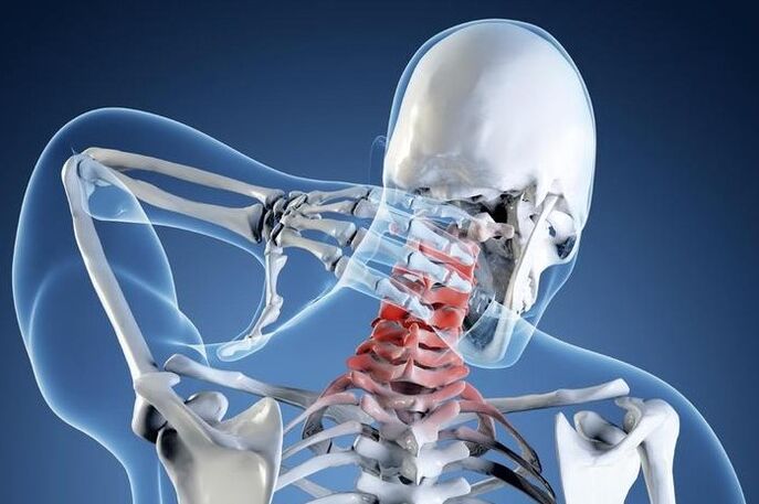 Osteochondróza 1. stupňa