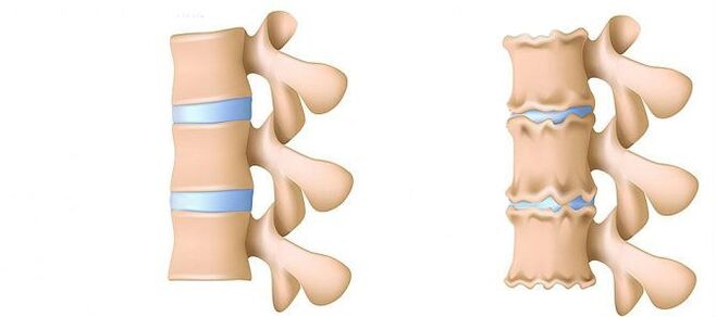 Osteochondróza bedrovej oblasti