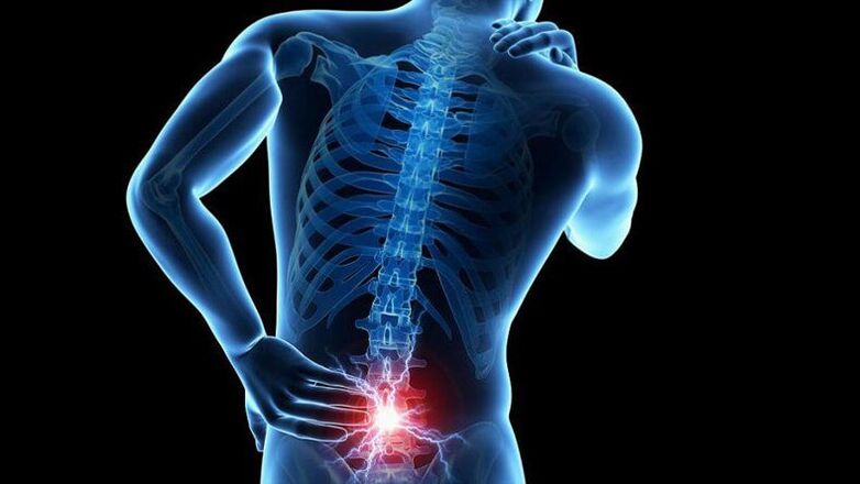 Príznaky bedrovej osteochondrózy